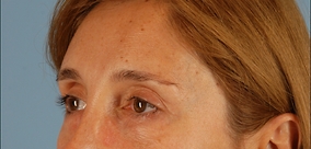 Eye Surgery Before & After Image