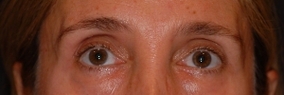 Eye Surgery Before & After Image