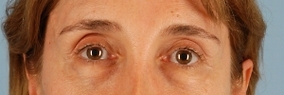 Eye Surgery Before & After Image