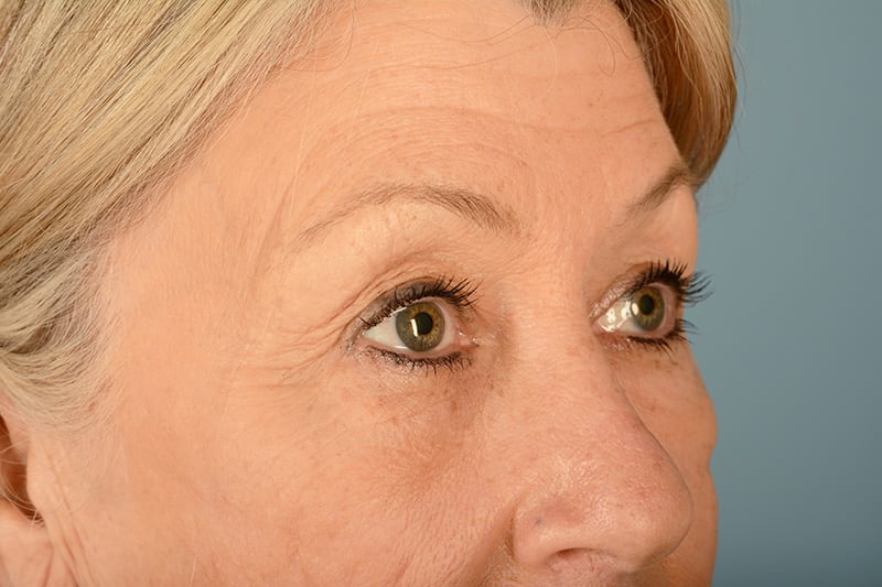 Eye Surgery Before & After Image