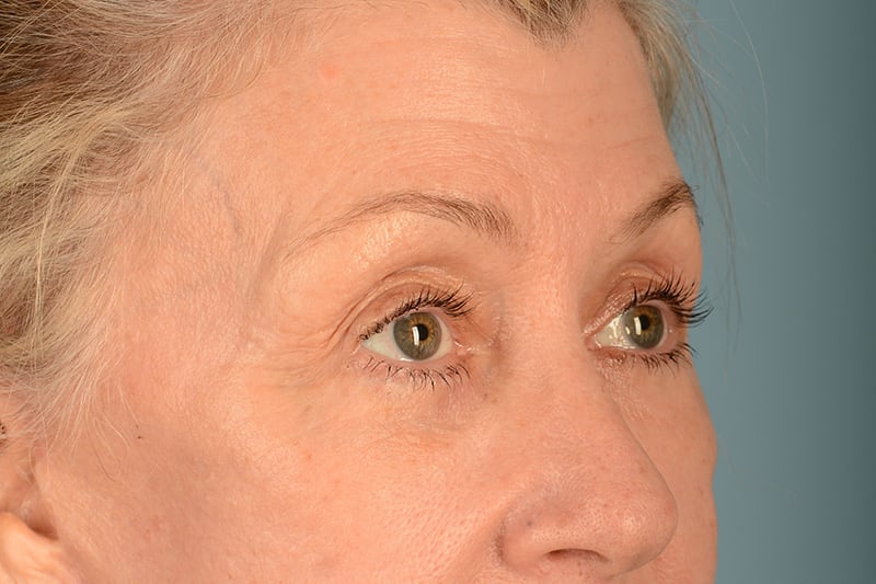 Eye Surgery Before & After Image