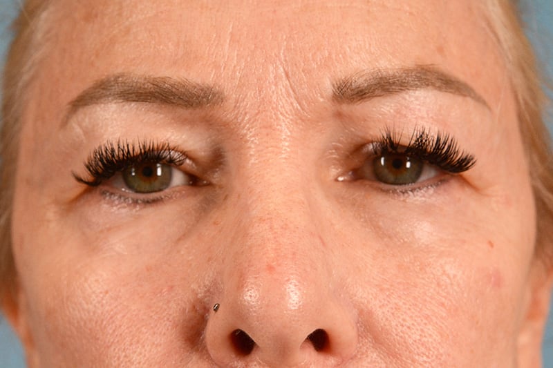 Eye Surgery Before & After Image