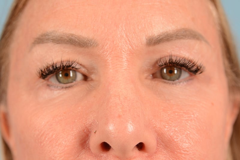 Eye Surgery Before & After Image