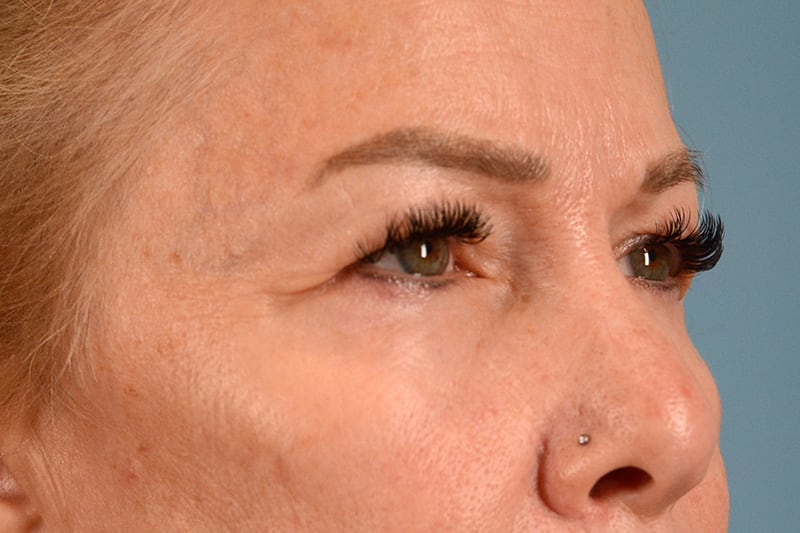 Eye Surgery Before & After Image