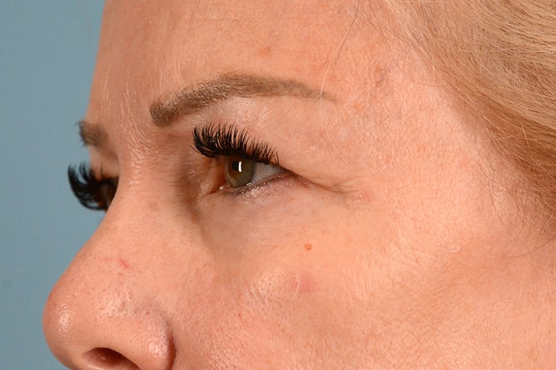 Eye Surgery Before & After Image