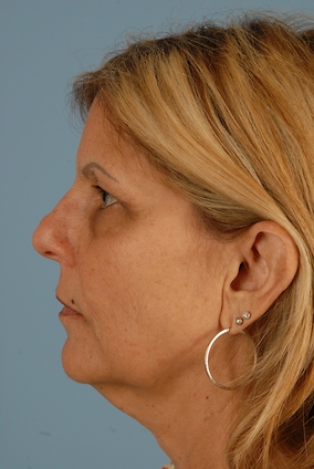 Neck Lift Before & After Image