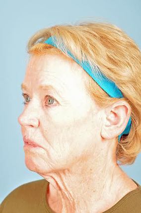 Neck Lift Before & After Image