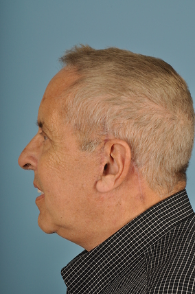 Neck Lift Before & After Image