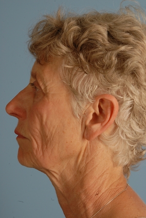 Neck Lift Before & After Image