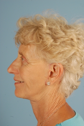 Neck Lift Before & After Image