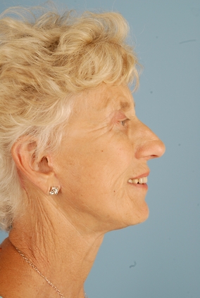 Neck Lift Before & After Image