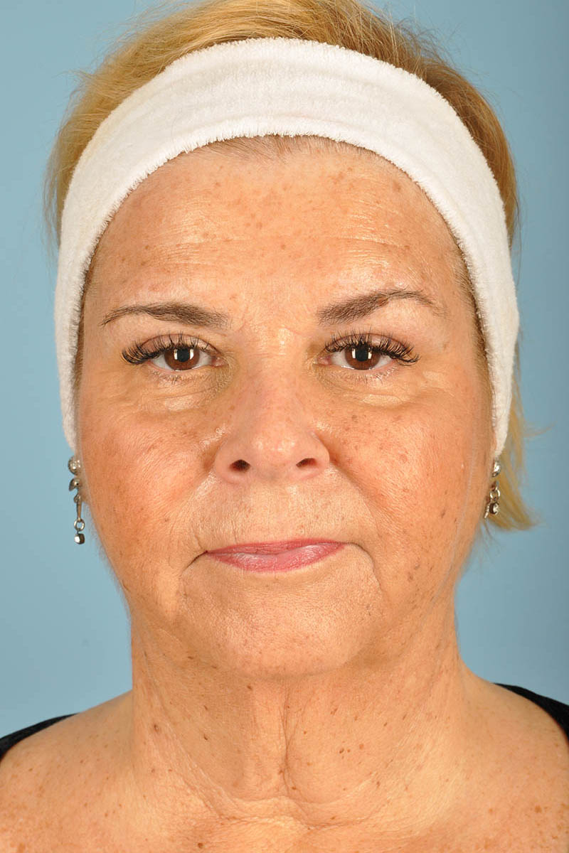 Neck Lift Before & After Image