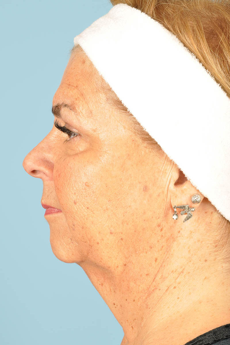 Neck Lift Before & After Image