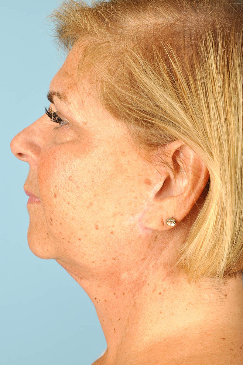 Neck Lift Before & After Image