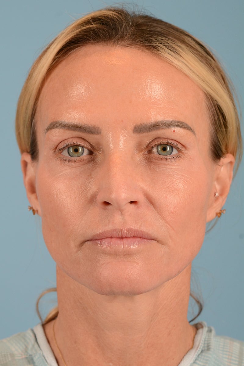 Neck Lift Before & After Image