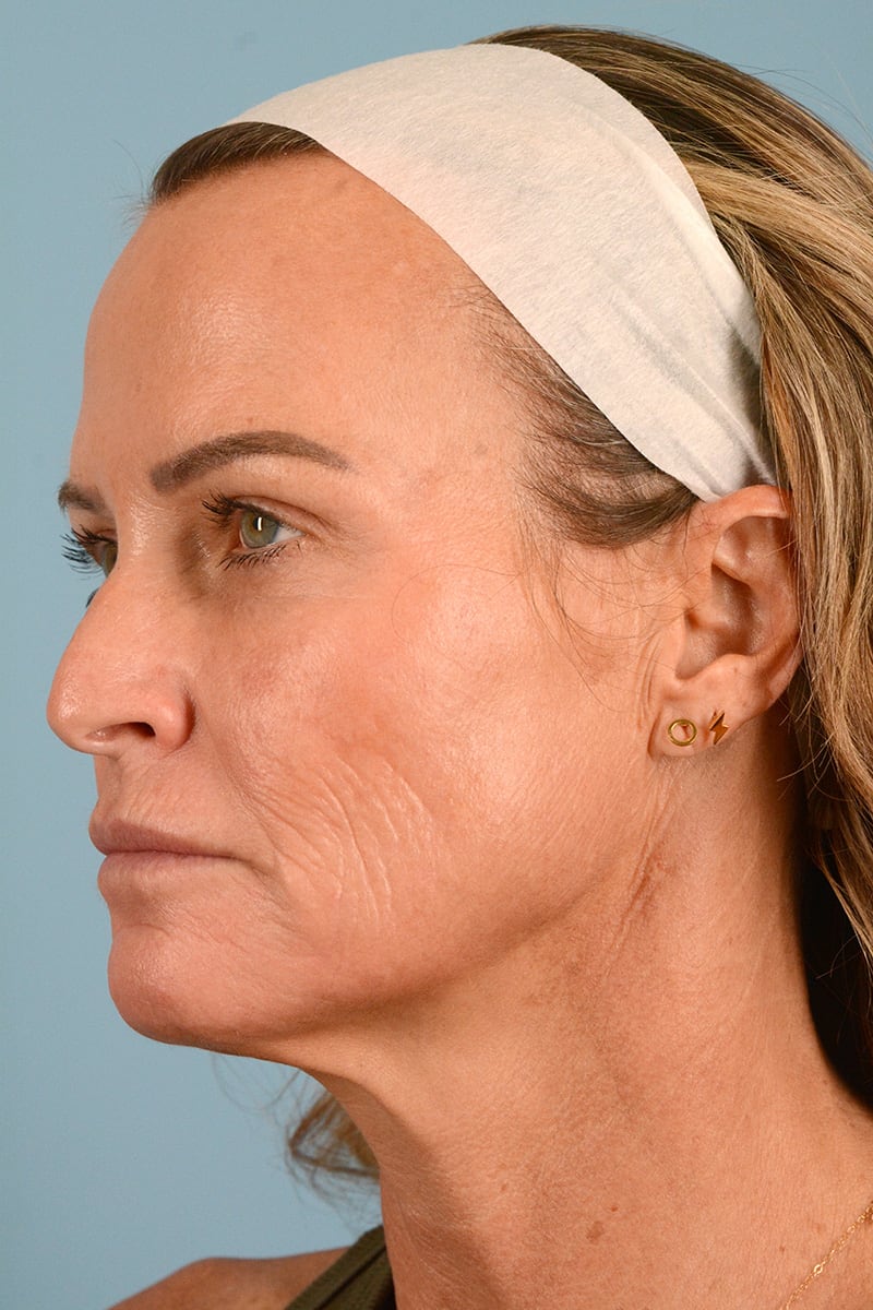 Neck Lift Before & After Image