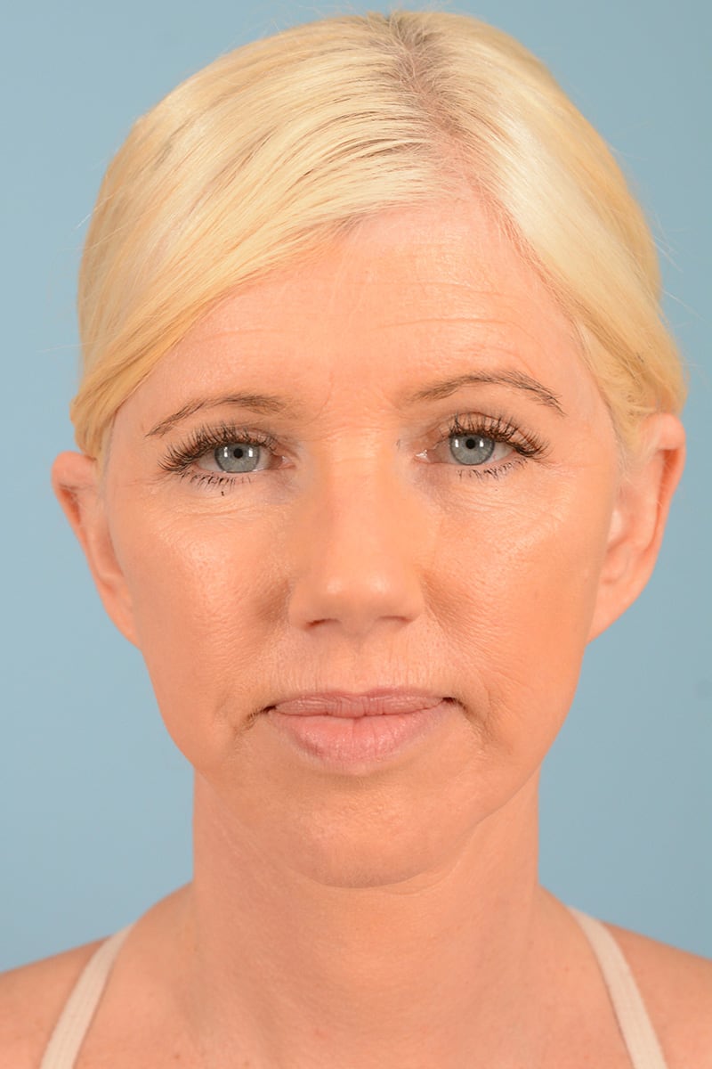 Neck Lift Before & After Image