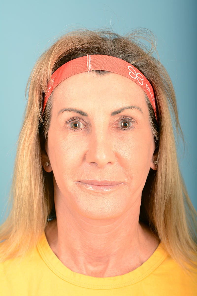 Neck Lift Before & After Image