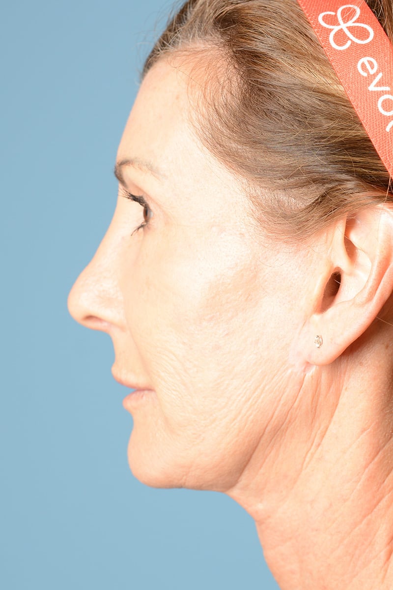 Neck Lift Before & After Image