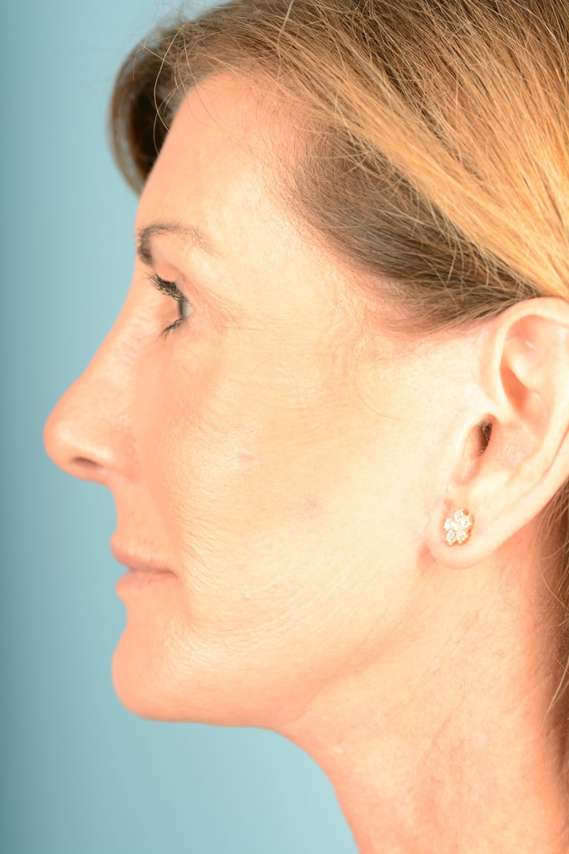 Neck Lift Before & After Image