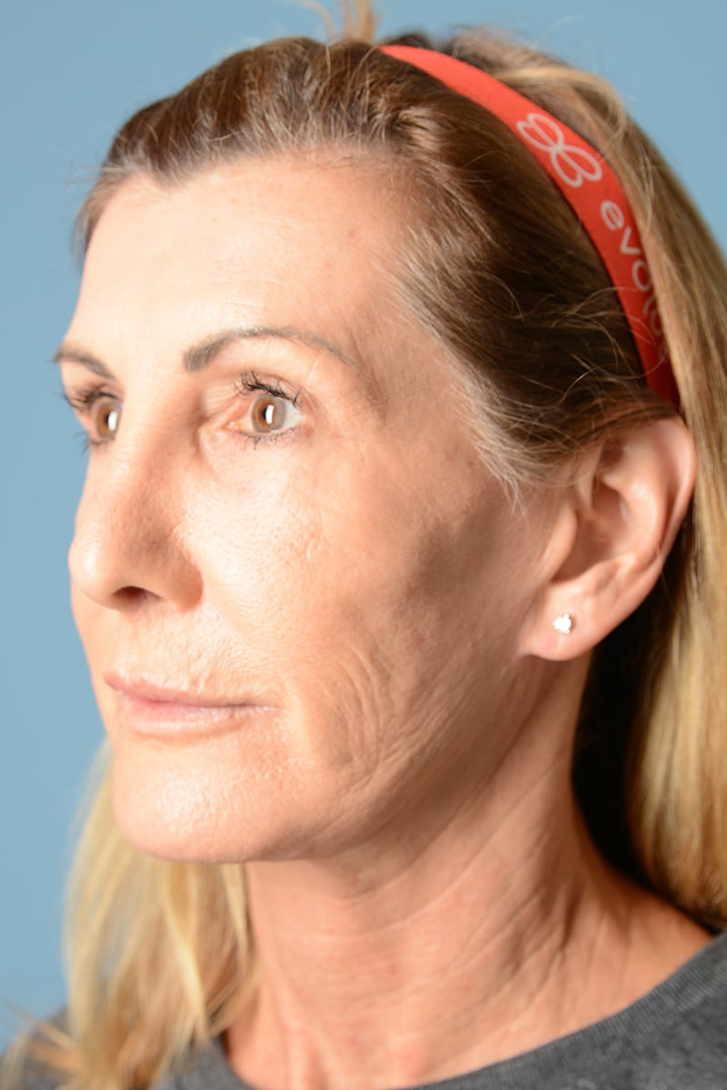 Neck Lift Before & After Image