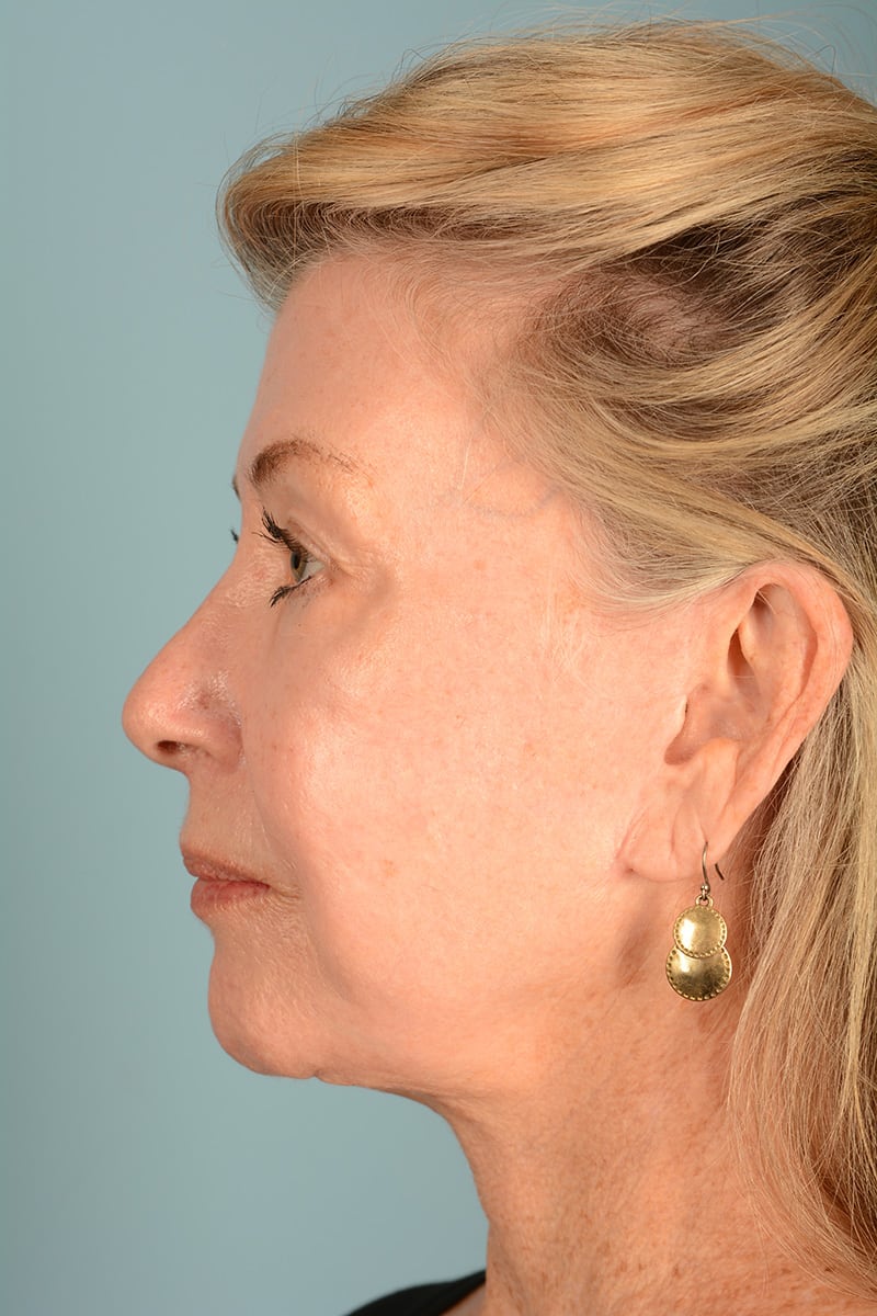 Neck Lift Before & After Image
