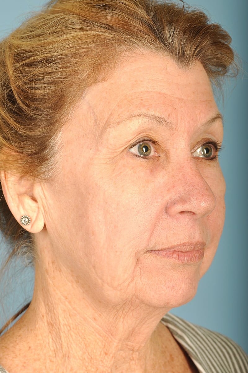 Neck Lift Before & After Image