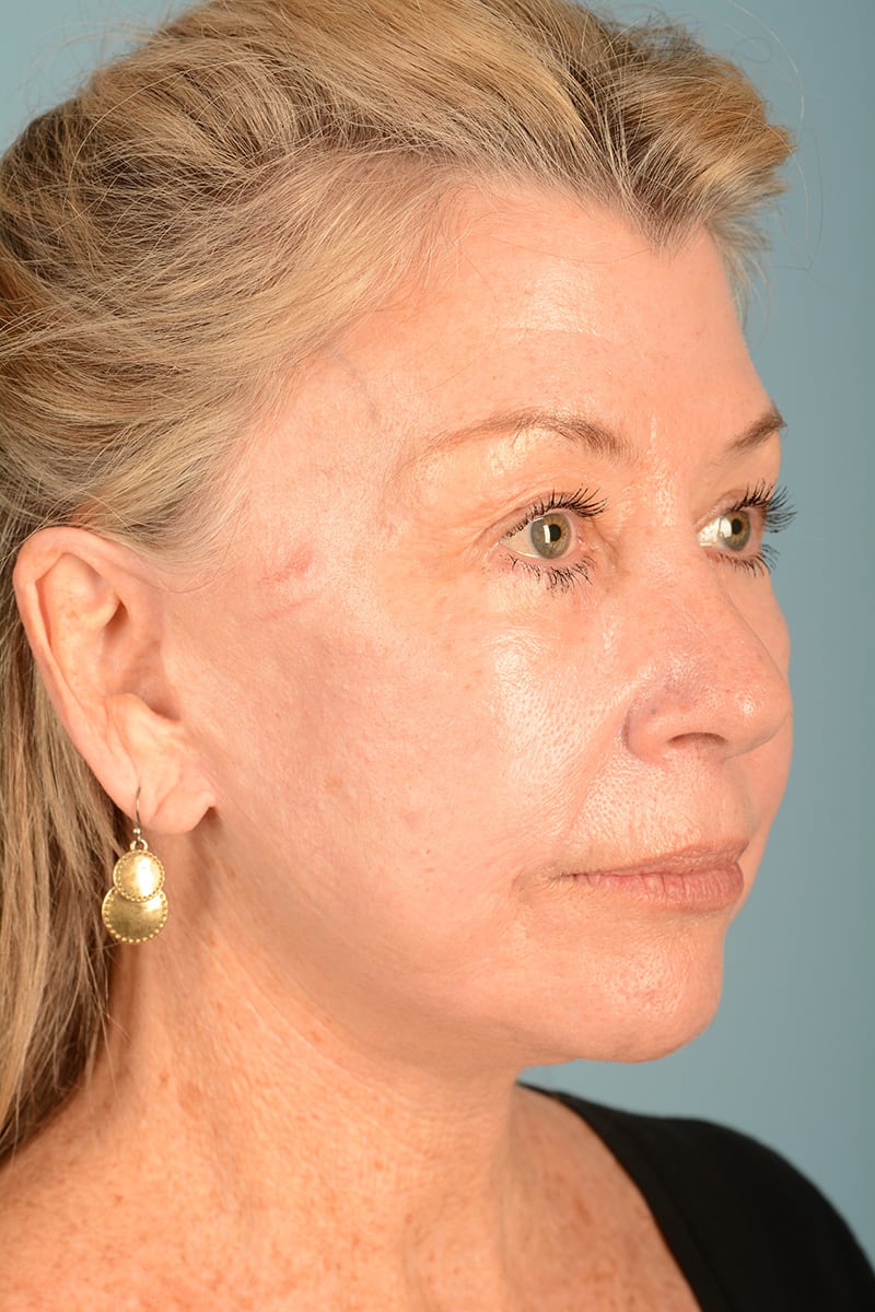 Neck Lift Before & After Image