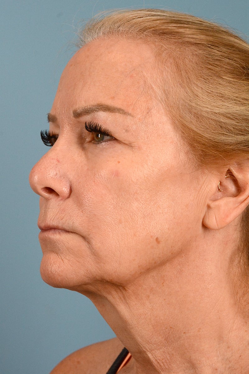 Neck Lift Before & After Image