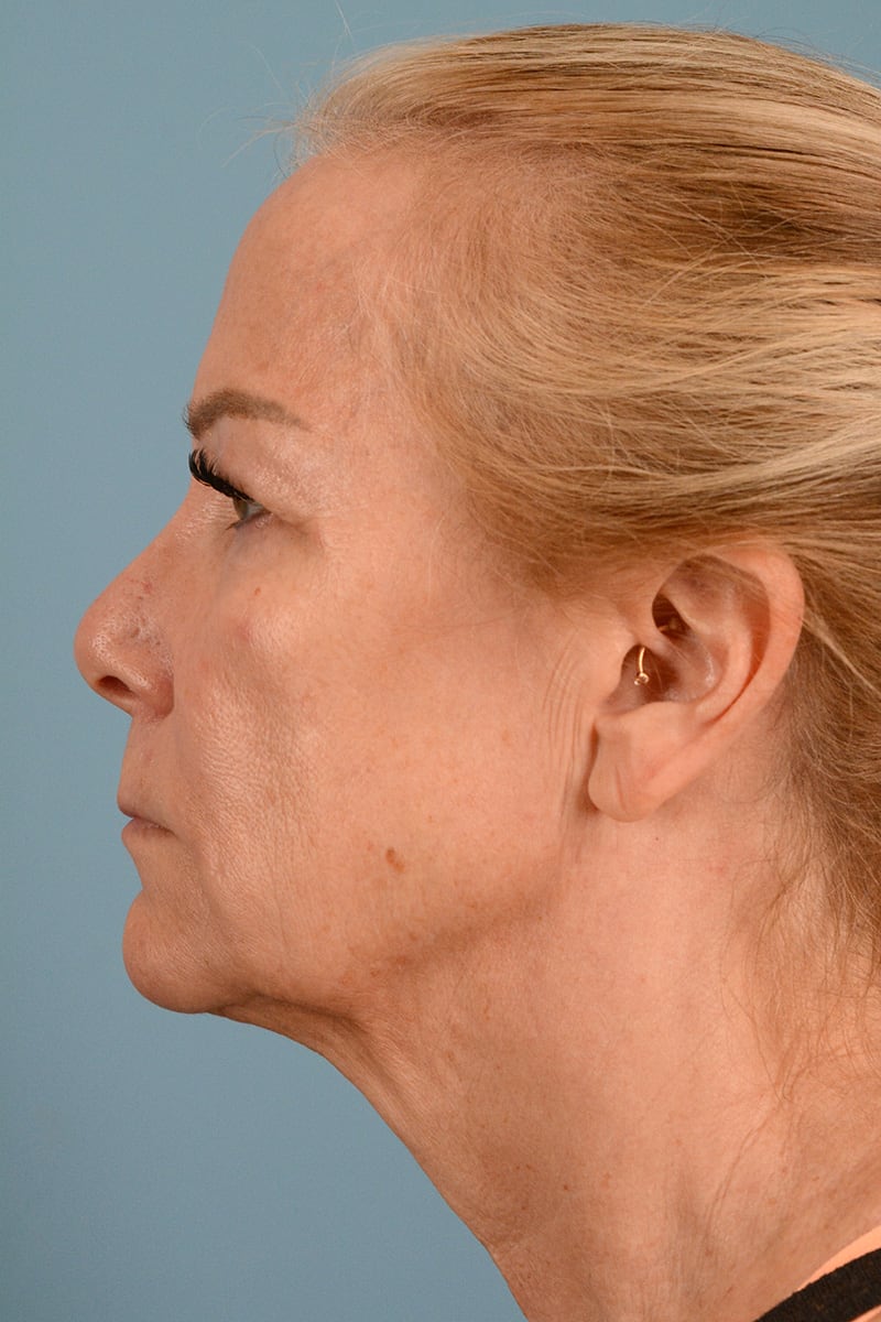 Neck Lift Before & After Image