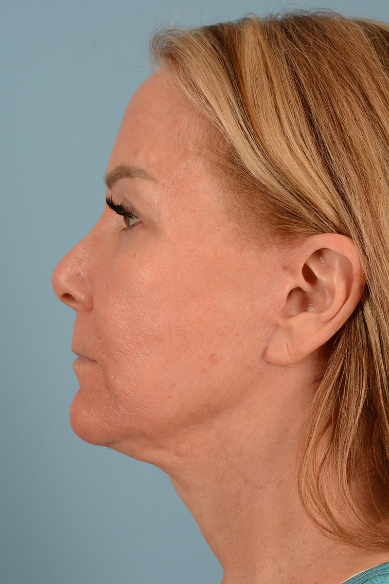 Neck Lift Before & After Image
