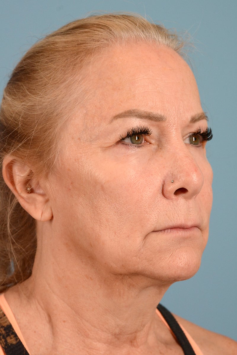 Neck Lift Before & After Image
