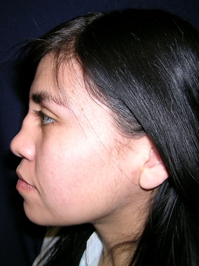 Rhinoplasty Before & After Image