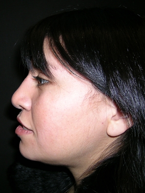 Rhinoplasty Before & After Image