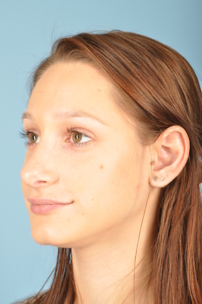 Rhinoplasty Before & After Image