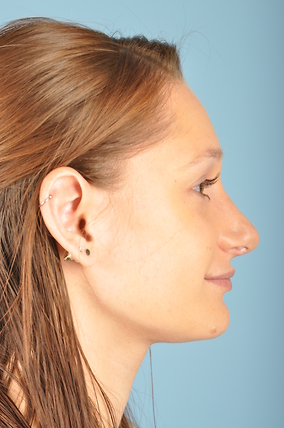 Rhinoplasty Before & After Image