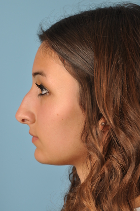 Rhinoplasty Before & After Image