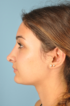 Rhinoplasty Before & After Image