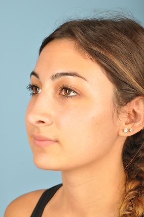 Rhinoplasty Before & After Image