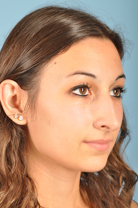 Rhinoplasty Before & After Image