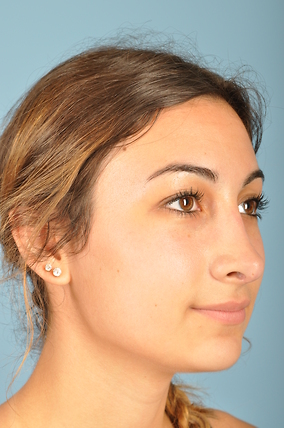 Rhinoplasty Before & After Image