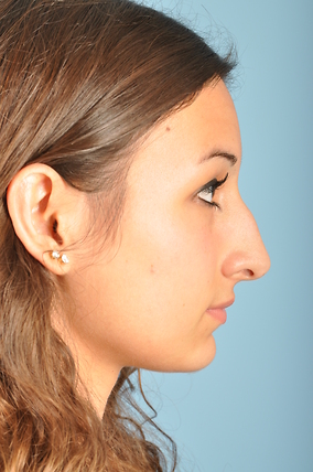 Rhinoplasty Before & After Image