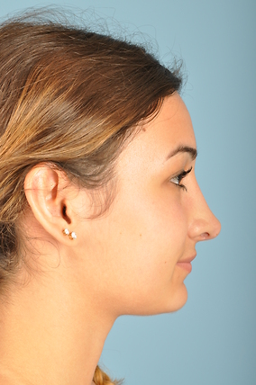 Rhinoplasty Before & After Image