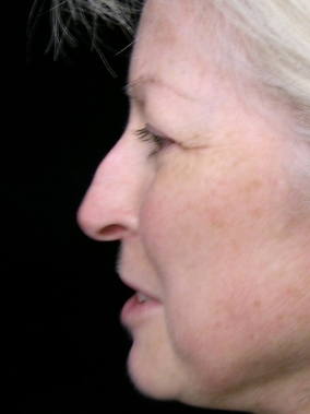 Rhinoplasty Before & After Image