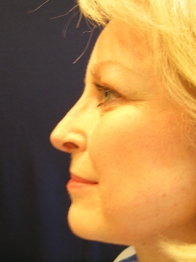 Rhinoplasty Before & After Image