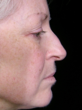 Rhinoplasty Before & After Image