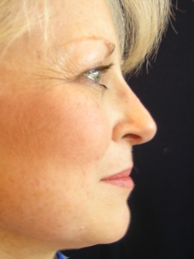 Rhinoplasty Before & After Image