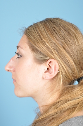 Rhinoplasty Before & After Image