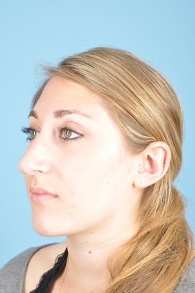 Rhinoplasty Before & After Image