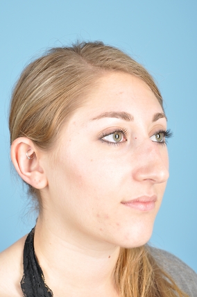 Rhinoplasty Before & After Image